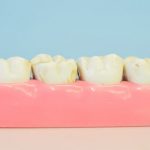 Wanneer verwijst de tandarts je door naar een mondhygiënist?